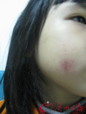 女童课堂尿急被老师打肿脸(图)